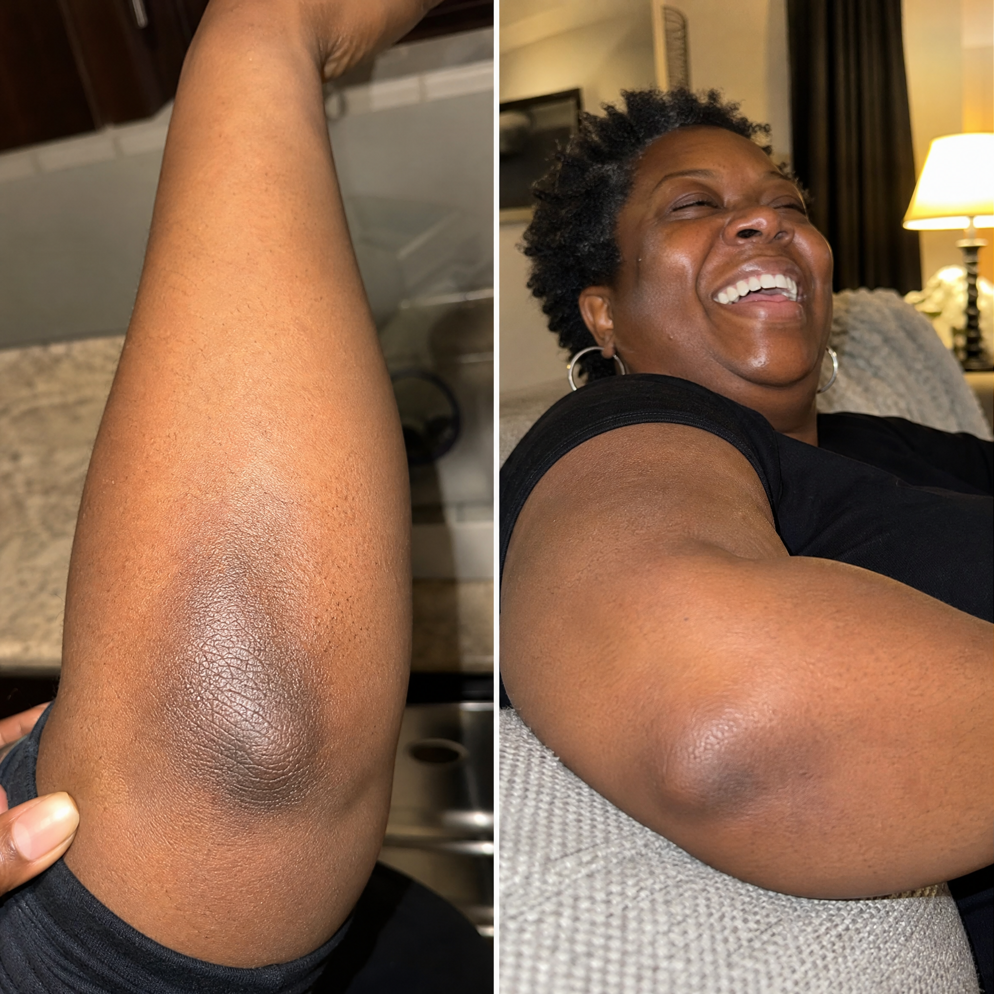 Reader's elbow before and after